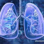 Lung conditions New AI test set to transform diagnosis